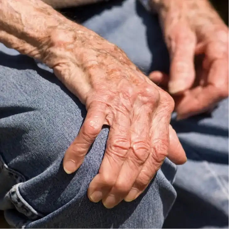 Osteoarthritis